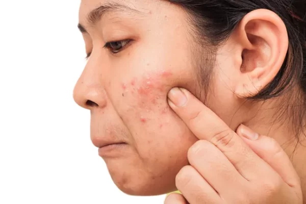 5 ingredients to treat acne using natural methods For girls with sensitive skin